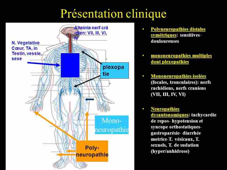 La D Finition Des Neuropathies Douloureuses